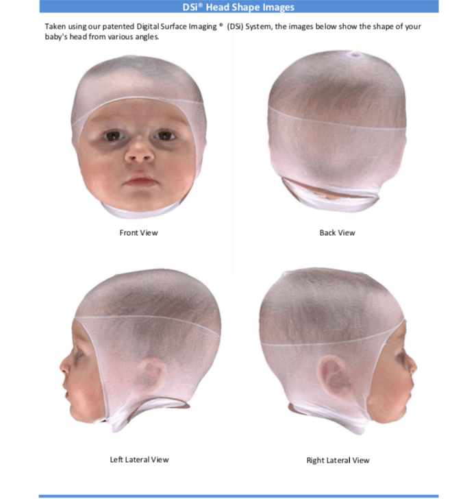 Cranial Technologies - Check out this DOC Band Baby in the arms of